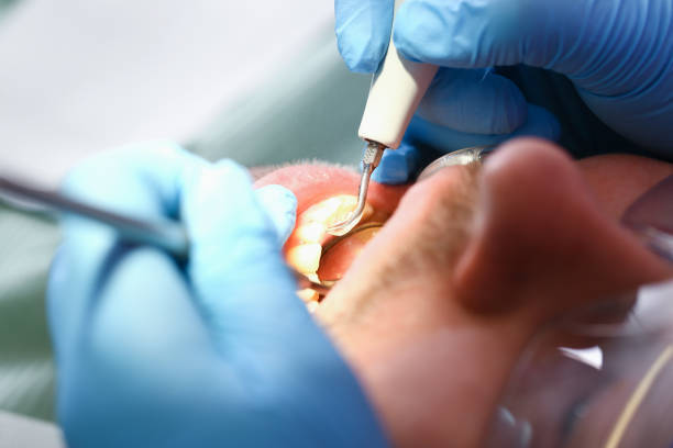 Best Emergency Root Canal Treatment in West Allis, WI